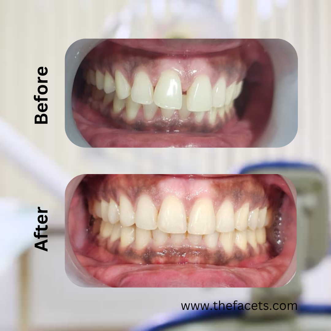 Before After Result 5